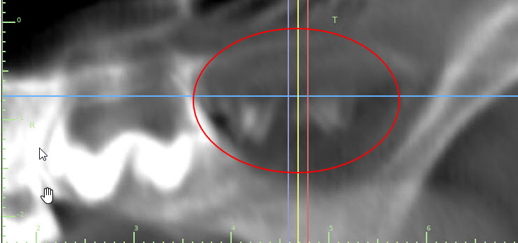 Age 15 week tooth bud formation
