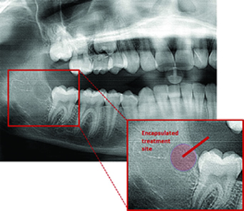 targeted microwave ablation that prevents wisdom teeth from ever forming