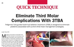 Third Molar Management article