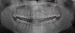 Upper 3rd molars hyper-erupted