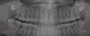 Extensive decay spread to adjacent teeth