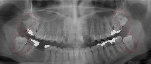 all four molars show signs of decay