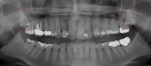 Severe gum infection requires extraction of 2nd and 3rd molars