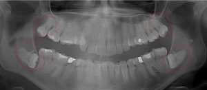 Upper 3rd Molars are hyper-erupting & decaying