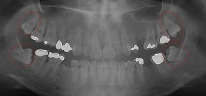 Prognosis for 2nd molars is poor