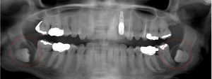 bilateral mandibular 3rd molars present with cysts