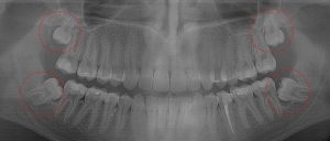 both lower 3rd molars are impacted, require immediate extraction
