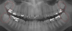 all four 3rd molars decaying