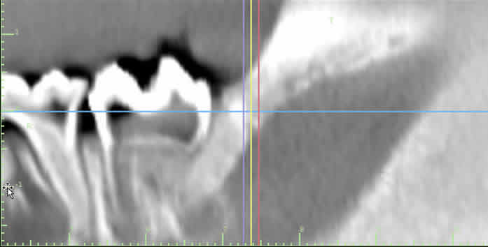 Age 20 weeks, no evidence of boy crypt