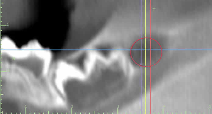 ablated tooth bud at 8 weeks