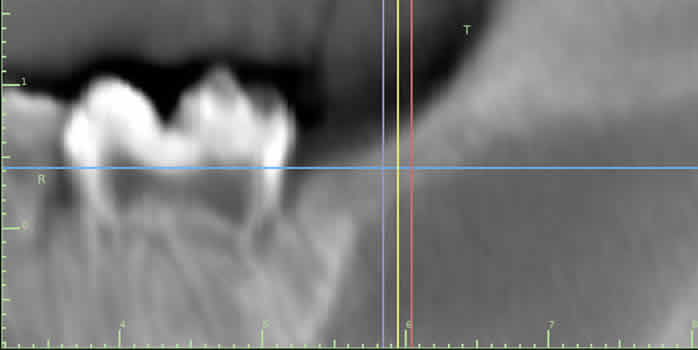 16 weeks post ablation, no evidence of tooth bud