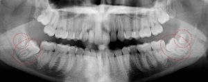 Supranumery wisdom teeth present