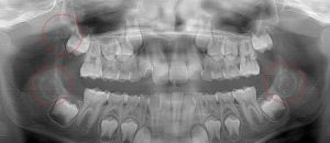 9 Year Old with 3 molars forming