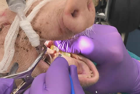 Deliver 30 - 45 second micro-ablation